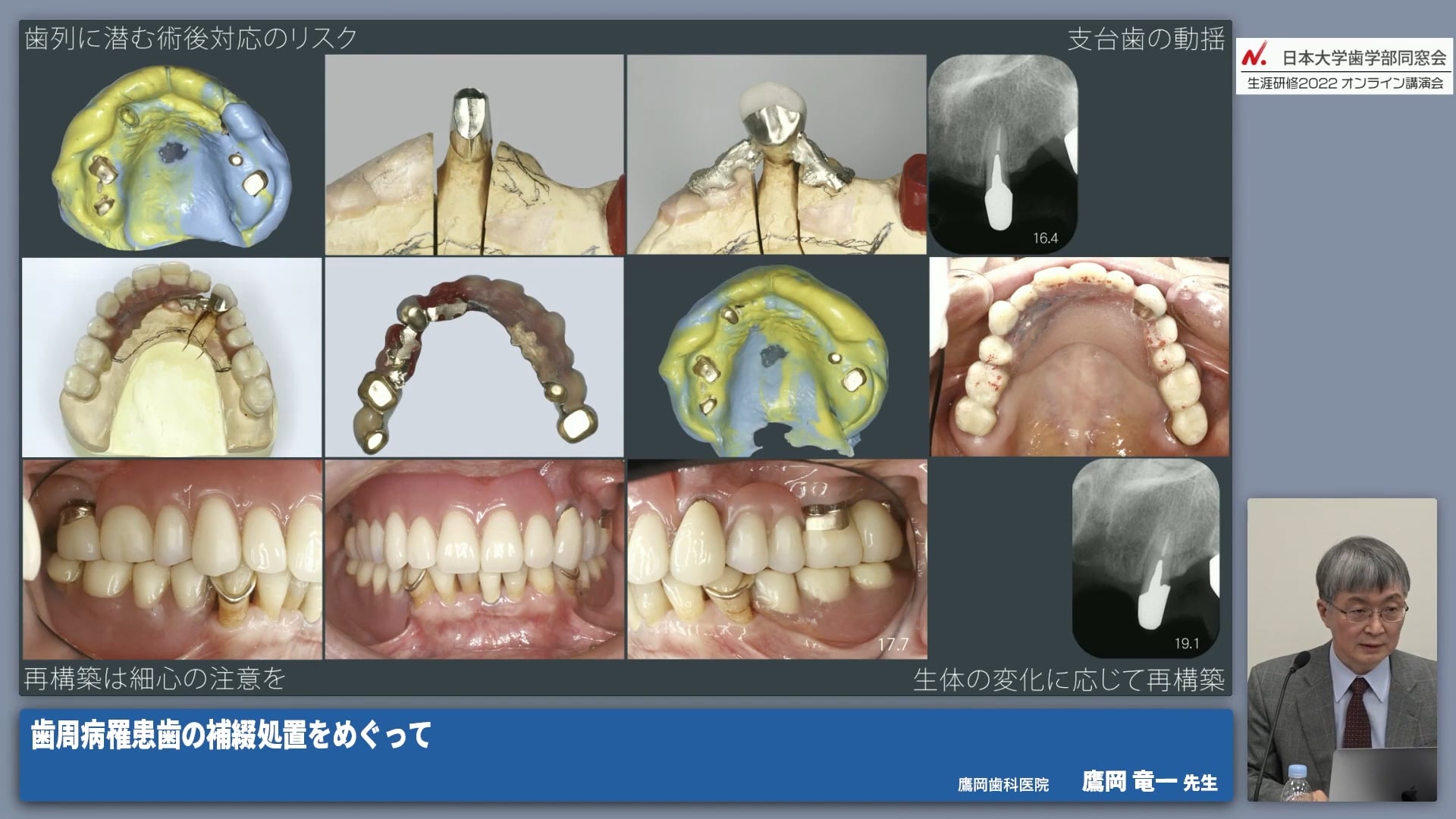 歯周病を抱えた欠損歯列 #6