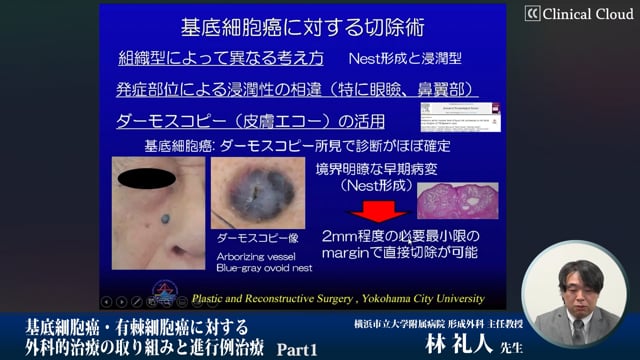 基底細胞癌・有棘細胞癌に対する外科的治療の取り組みと進行例治療　Part1