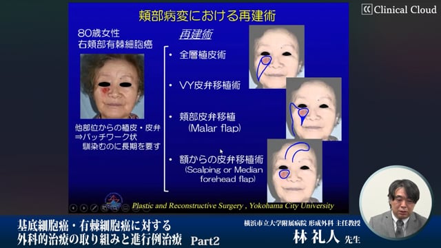 基底細胞癌・有棘細胞癌に対する外科的治療の取り組みと進行例治療　Part2