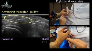 A1 Pulley Release Procedure