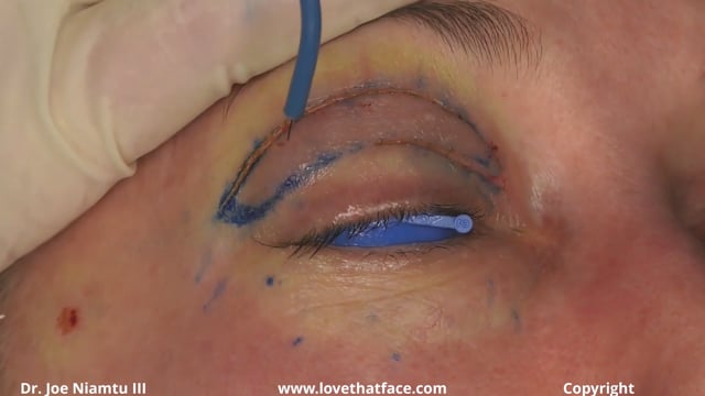 Blepharoplasty - Pressureless & bloodless incision with indirect coagulation