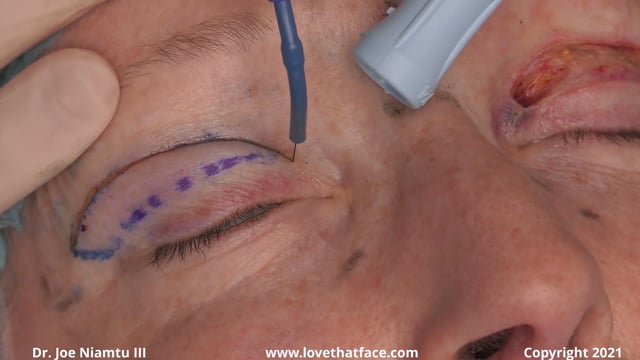 Upper Blepharoplasty - Story and Incision Edited reduced