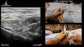 Iliopsoas Bursa Injection