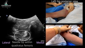 Sciatic Nerve Hydrodissection at the Quadratus Femoris