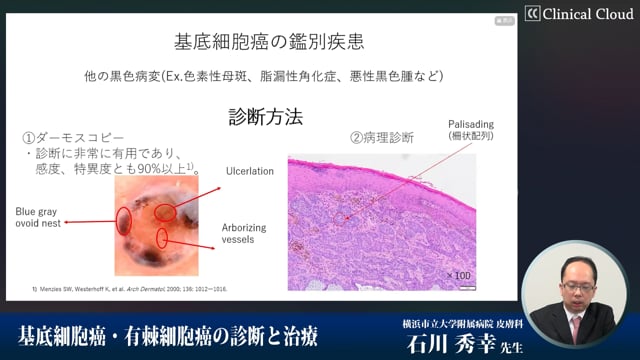 基底細胞癌・有棘細胞癌の診断と治療