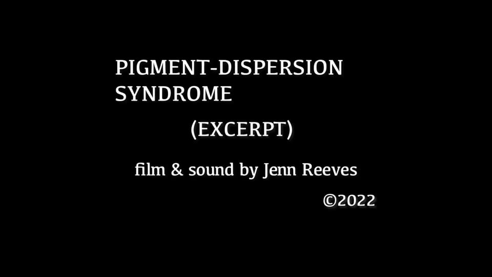 Pigment-Dispersion Syndrome