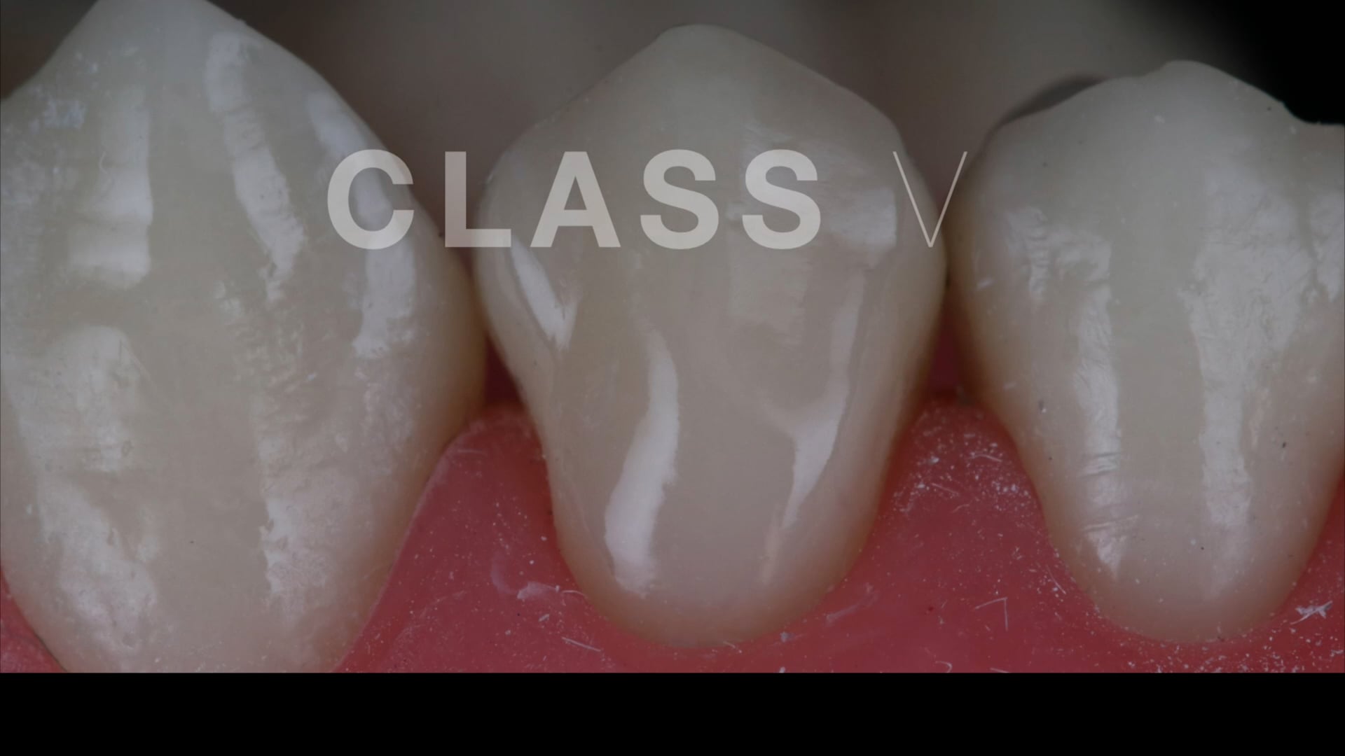 Class V with Microfill on Vimeo