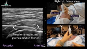 Gluteus Medius and Minimus Tendon Needle Tenotomy