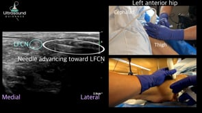 Lateral Femoral Cutaneous Nerve Hydrodissection and Block