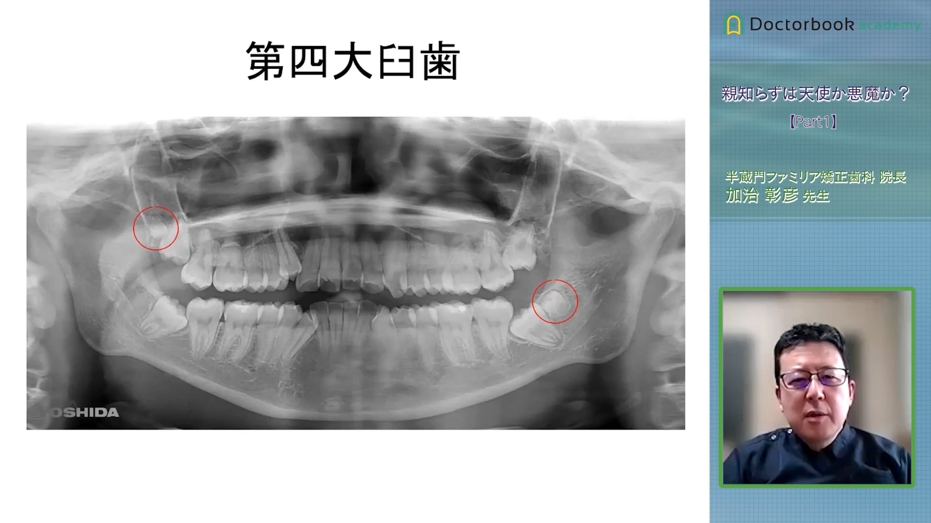 臨床知見録_下顎埋伏智歯抜歯_第四大臼⻭について