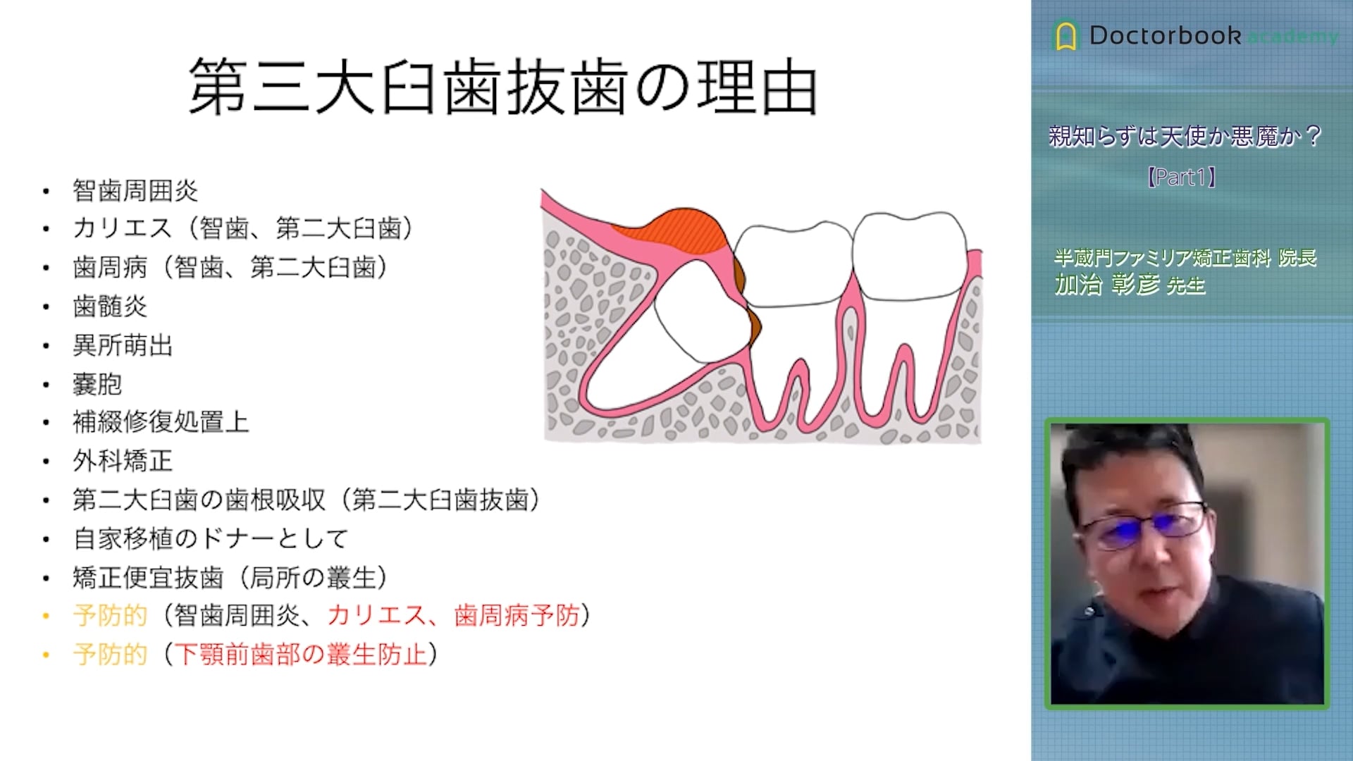 臨床知見録_下顎埋伏智歯抜歯_第三大臼歯抜歯の理由①