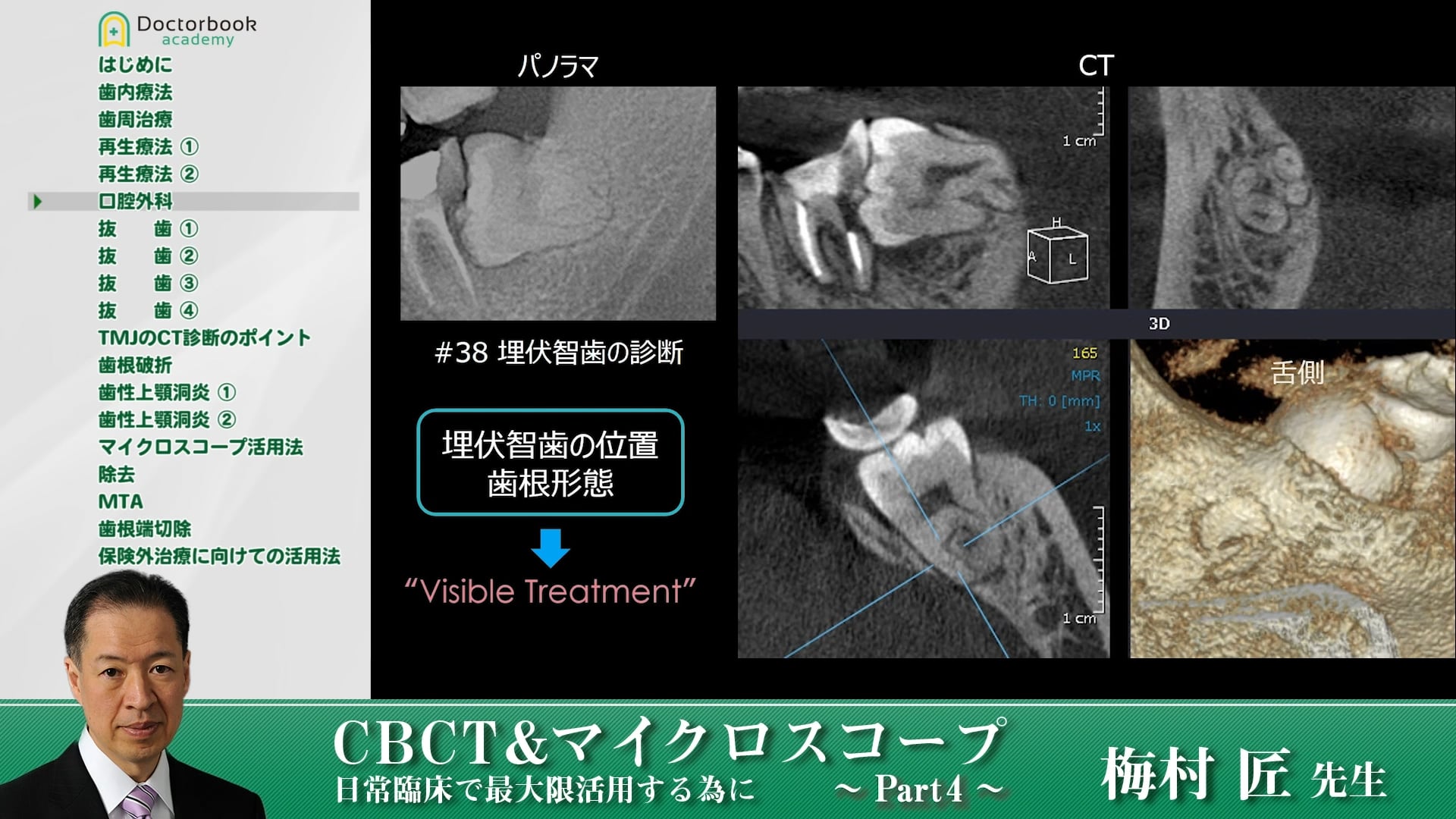 臨床知見録_下顎埋伏智歯抜歯_口腔外科での活用方法