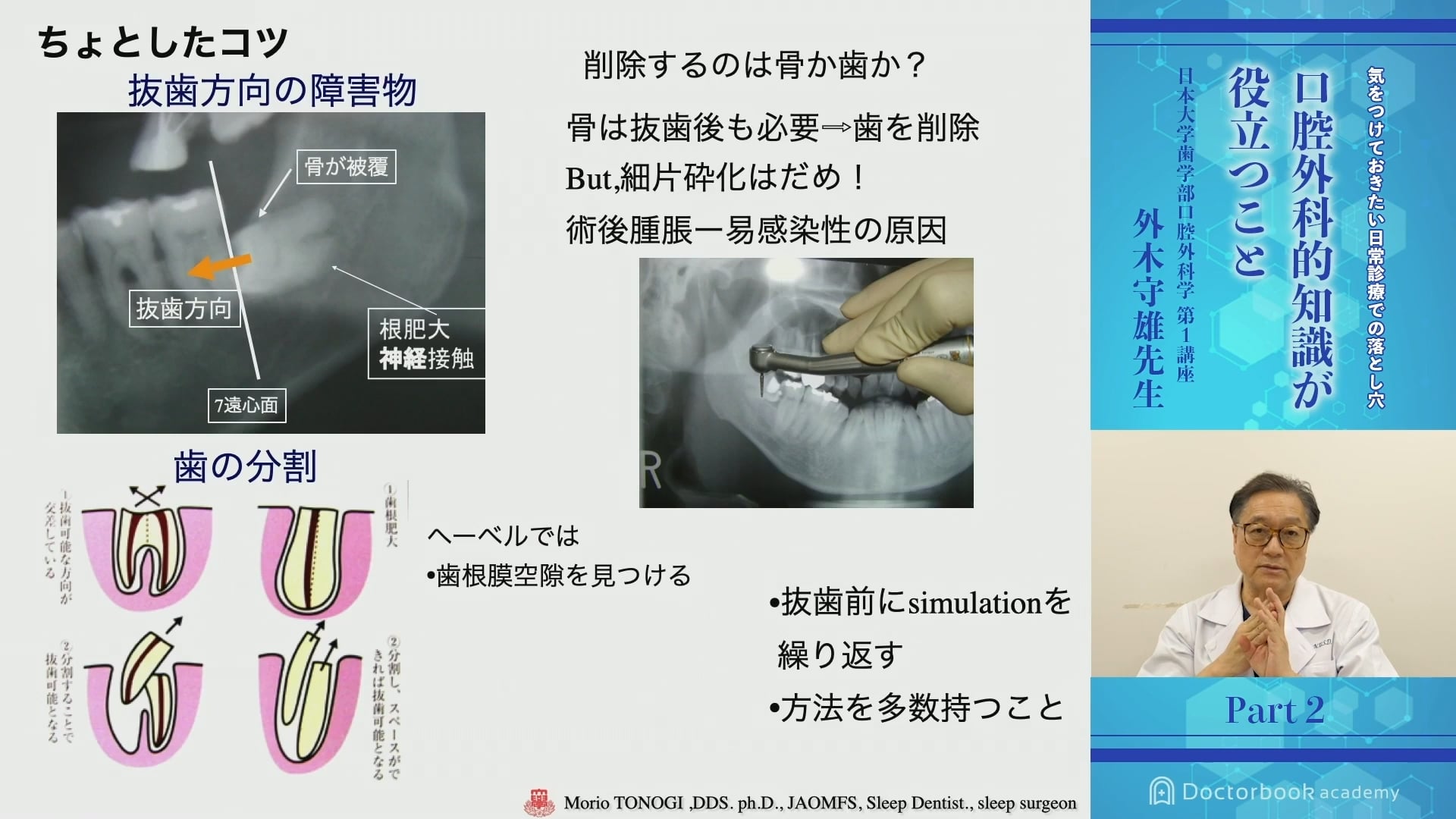 臨床知見録_下顎埋伏智歯抜歯_ヘーベルの使い方