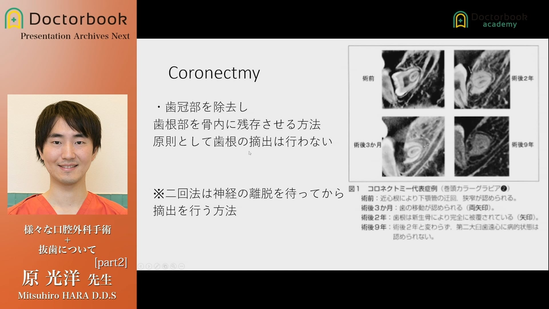 臨床知見録_下顎埋伏智歯抜歯_Coronectomyについて