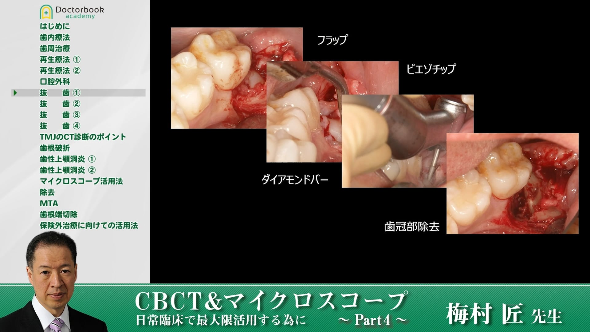 臨床知見録_下顎埋伏智歯抜歯_ピエゾの有用性