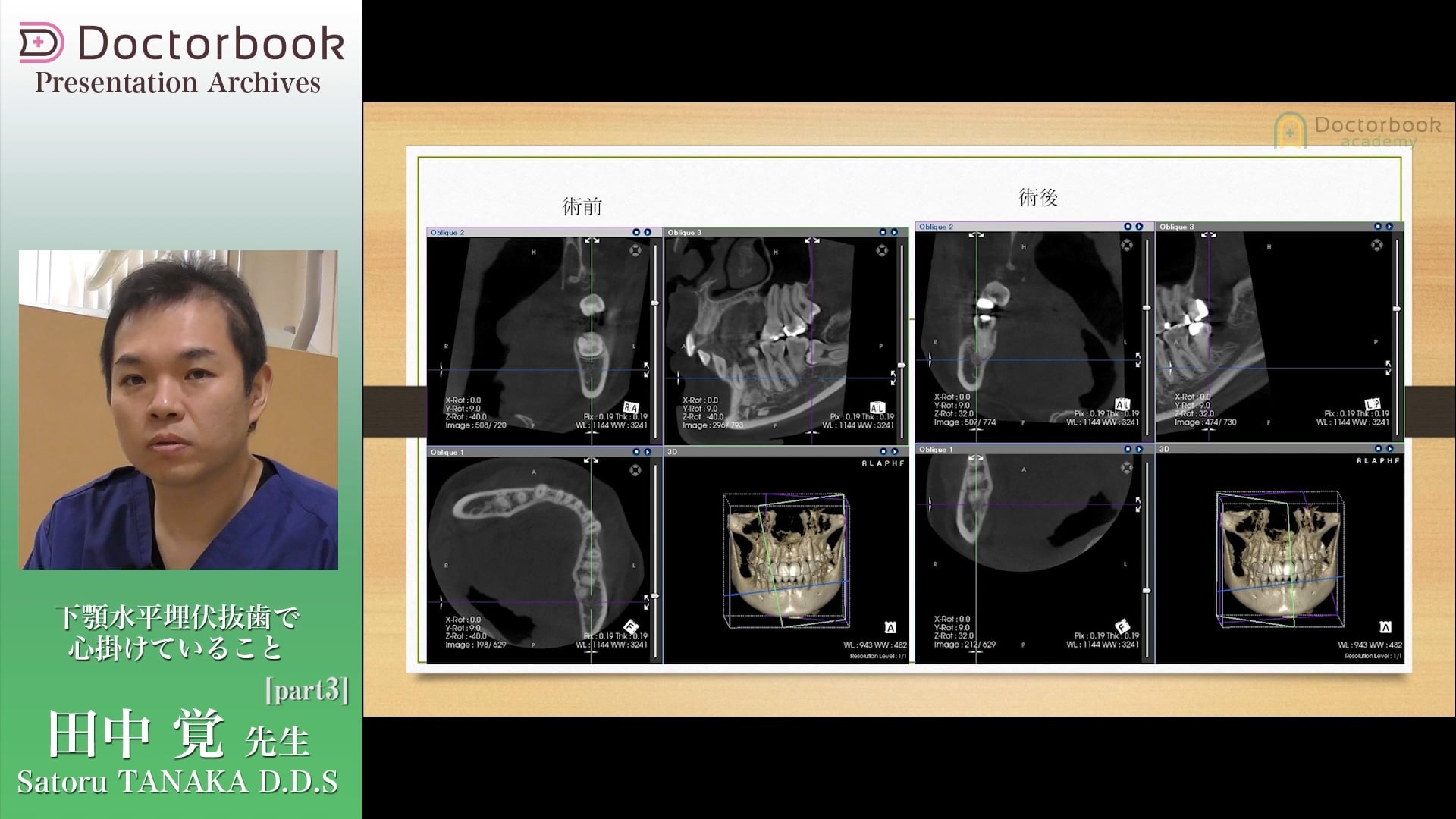 臨床知見録_下顎埋伏智歯抜歯_神経麻痺の説明