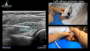 Median Nerve Hydrodissection at the Pronator Teres