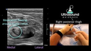 Hydrodissection Basics