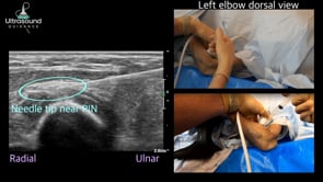 Posterior Interosseous Nerve Hydrodissection