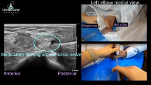 Ulnar Nerve Hydrodissection at the Medial Elbow