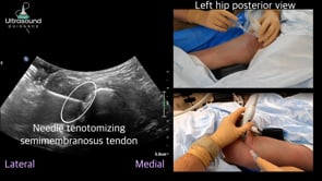 Hamstring and Adductor Magnus Needle Tenotomy