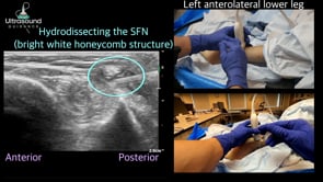 Superficial Fibular Nerve Hydrodissection at the Ankle