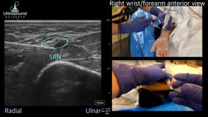 Superficial Radial Nerve Hydrodissection