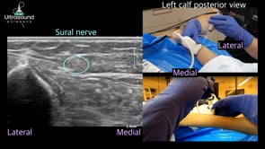 Sural Nerve Hydrodissection