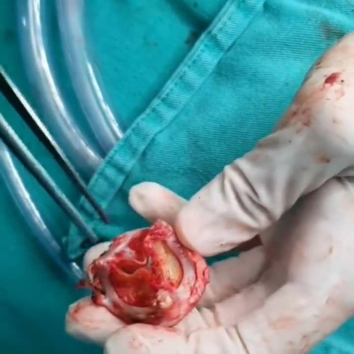Сердечный клапан искусственный