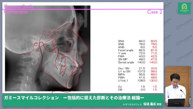 典型的なガミースマイルの症例およびまとめ