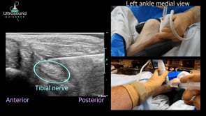 Tibial Nerve Hydrodissection at the Medial Ankle