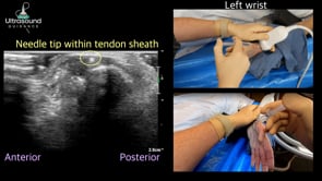 First Dorsal Compartment Injection