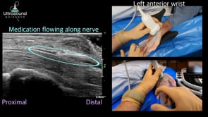 Carpal Tunnel Injection Distal to Proximal Approach
