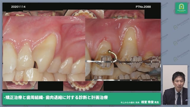 矯正治療中に歯肉退縮が認められている症例・歯肉移植法「VISTA」の外科手術│相宮 秀俊先生 #1