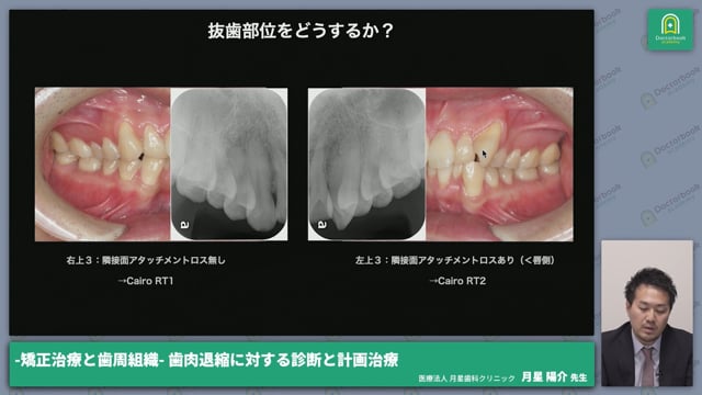 歯肉退縮のエビデンスと歯周組織フェノタイプの定義、Cairoの分類に関する解説│月星 陽介先生 #2