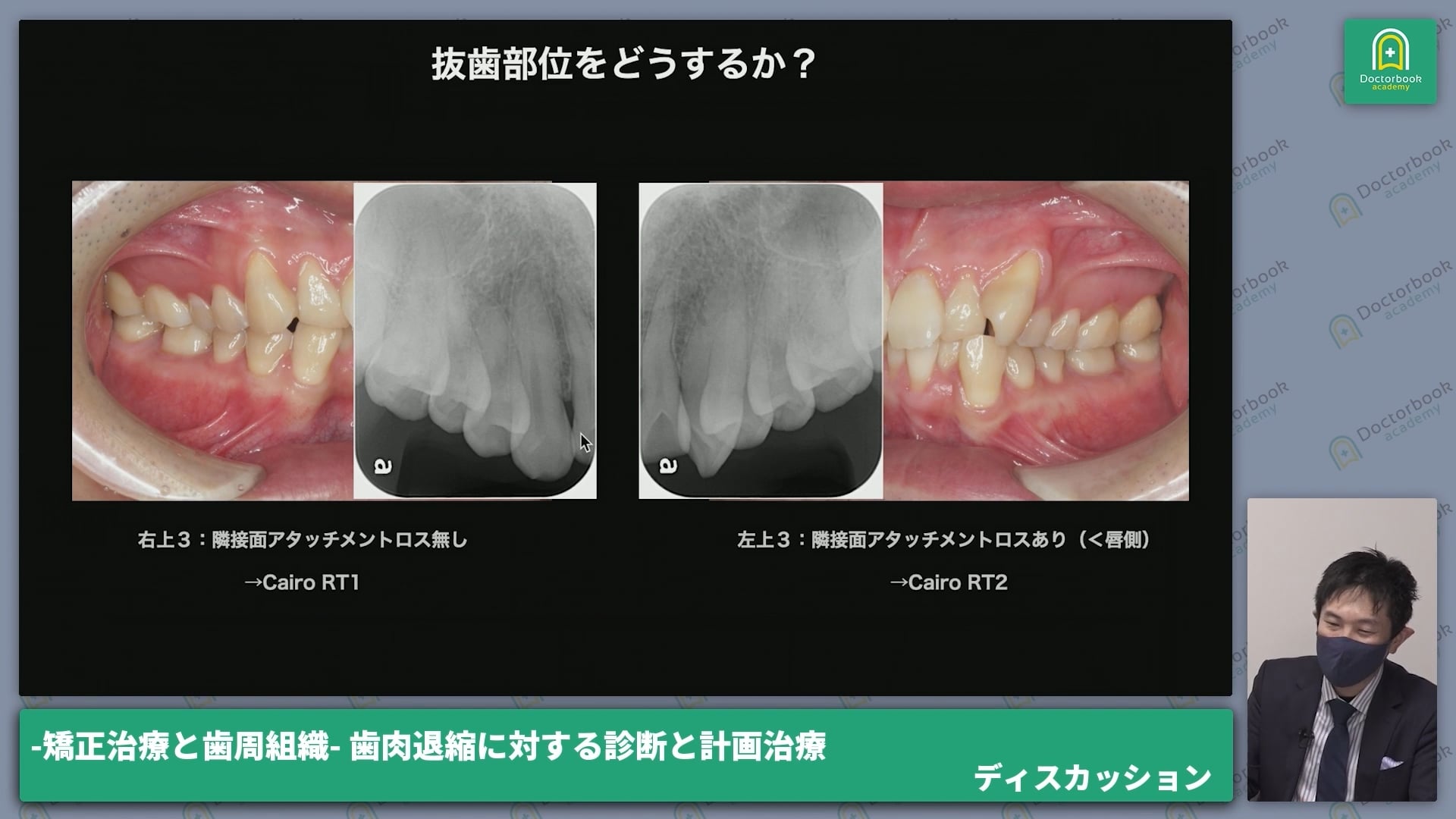 「矯正治療と歯肉退縮」についてのディスカッション│相宮 秀俊先生 月星 陽介先生 #3