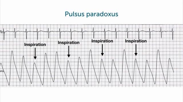 What is a pulsus paradoxus?