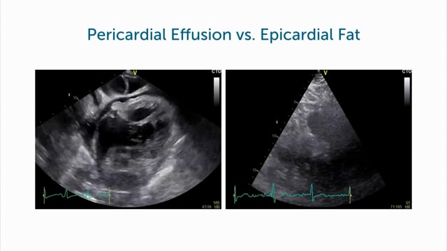 How can I differentiate epicardial fat from pericardial effusion?