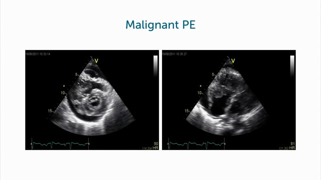 Examples of malignant pericardial effusion