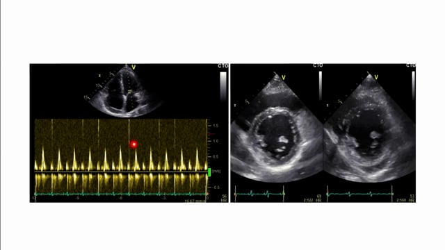Case: Athlete with constrictive pericarditis