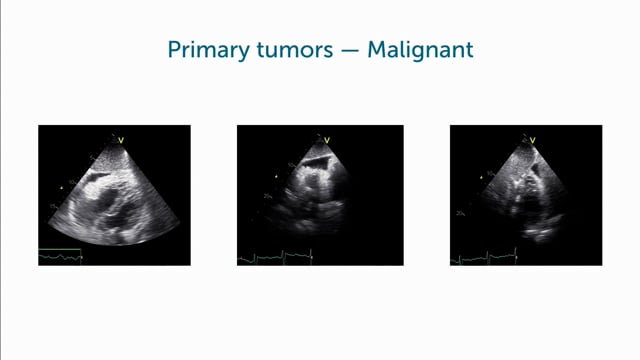 What does a malignant tumor of the pericardium look like in echocardiography?