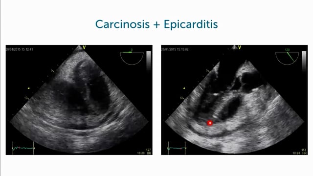 What are secondary tumors of the pericardium?