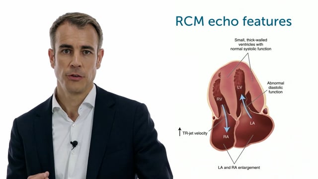 What are the typical echo features of RCM?