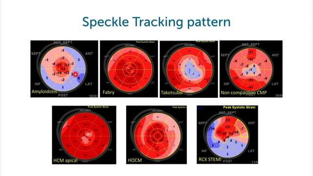 Does M-Mode and speckle tracking play an important role in diagnosing RCM?