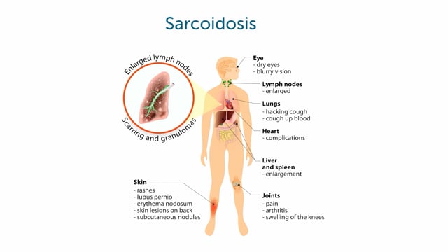 What is cardiac sarcoidosis?
