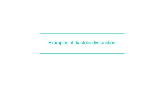 Examples of diastolic dysfunction