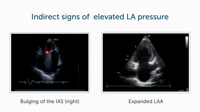 Indirect signs of elevated LA pressure