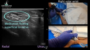 Ulnar Nerve Hydrodissection at the Wrist