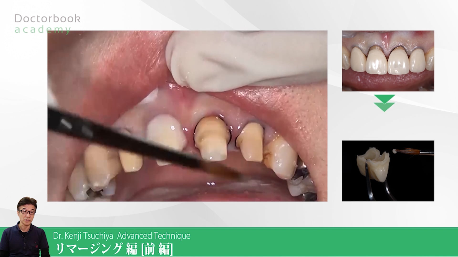 臨床知見録_プロビジョナル_ウォッシュを2回に分ける意義