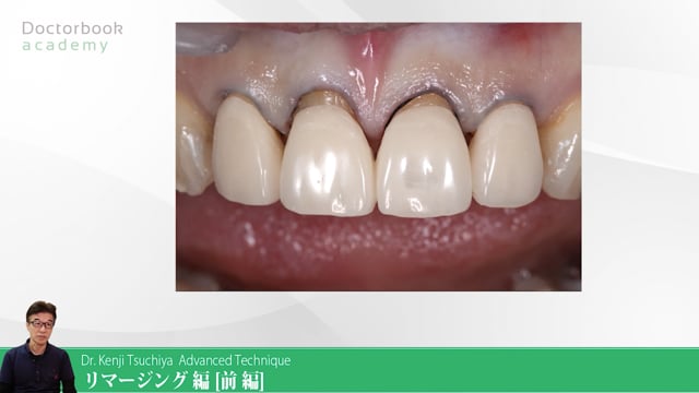 臨床知見録_プロビジョナル_ウォッシュ時の浮き上がらないようにするテクニック
